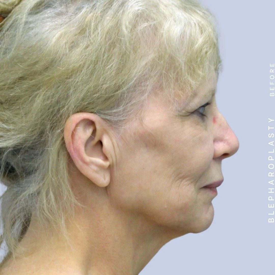Face & Neck Before & After Gallery - Patient 120868687 - Image 7