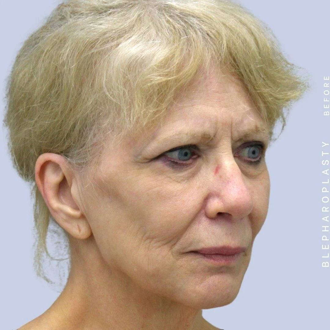 Face & Neck Before & After Gallery - Patient 120868687 - Image 9