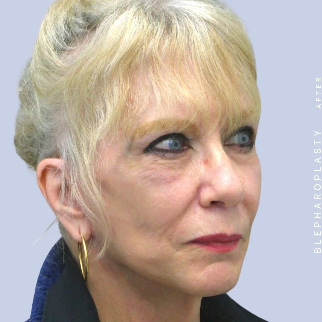 Face & Neck Before & After Gallery - Patient 120868687 - Image 10