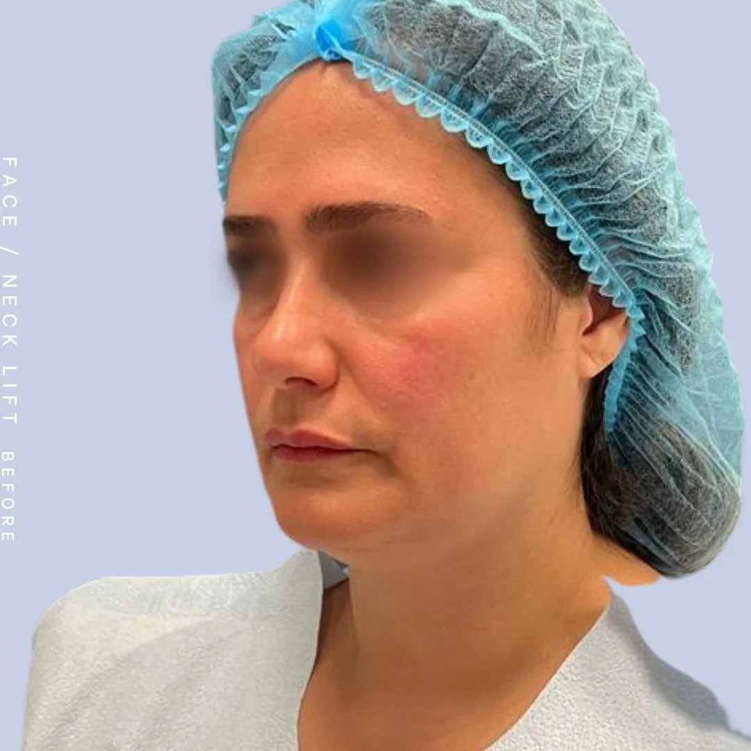 Face & Neck Before & After Gallery - Patient 122053840 - Image 1