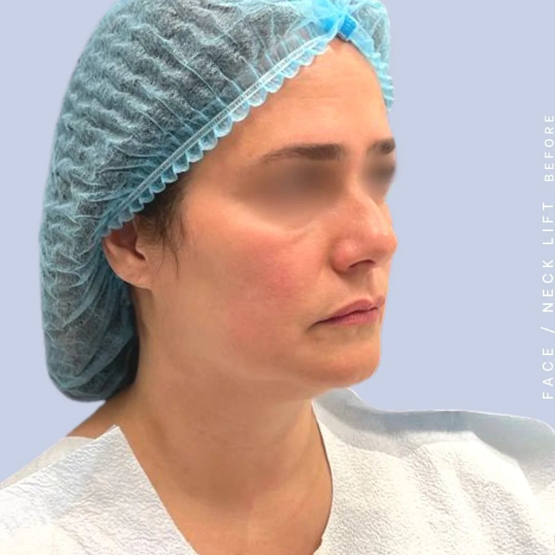 Face & Neck Before & After Gallery - Patient 122053840 - Image 5