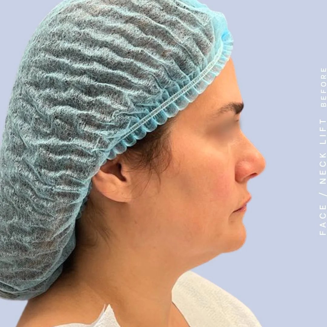 Face & Neck Before & After Gallery - Patient 122053840 - Image 7