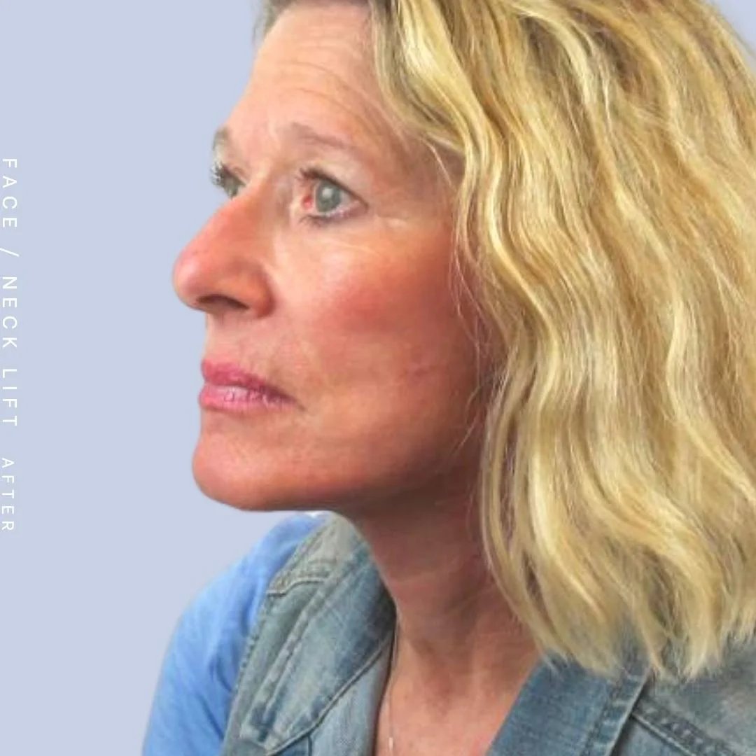 Face & Neck Before & After Gallery - Patient 122289924 - Image 4