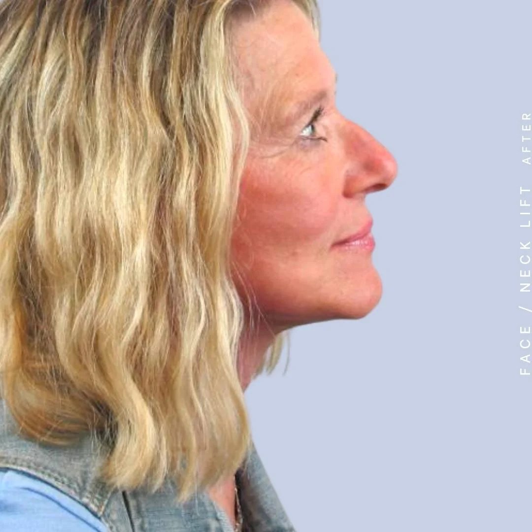 Face & Neck Before & After Gallery - Patient 122289924 - Image 10