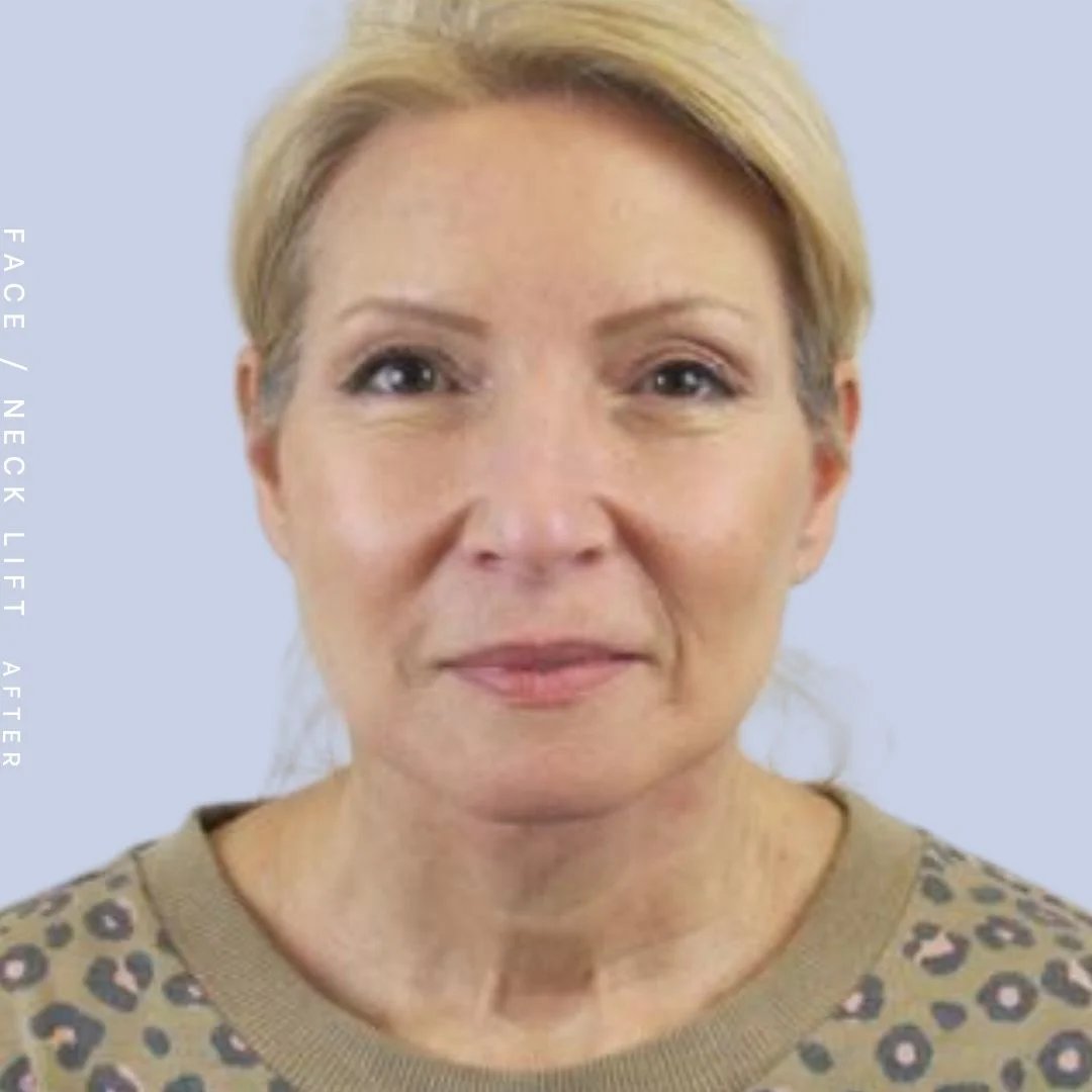 Face & Neck Before & After Gallery - Patient 119147235 - Image 2