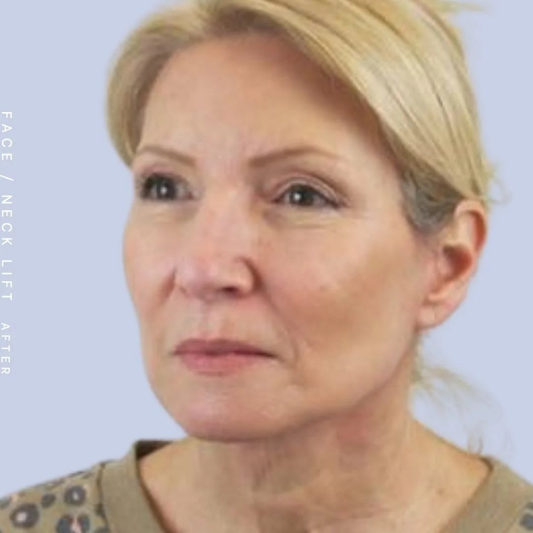 Face & Neck Before & After Gallery - Patient 119147235 - Image 4