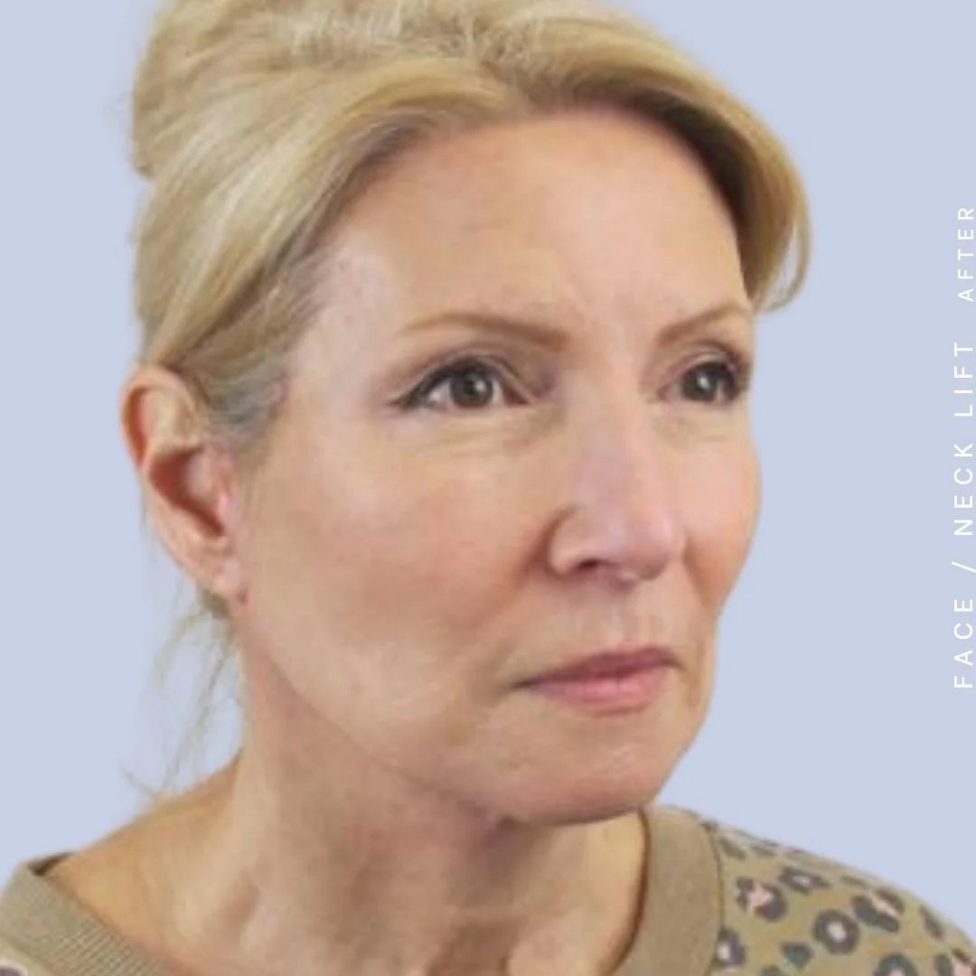 Face & Neck Before & After Gallery - Patient 119147235 - Image 10