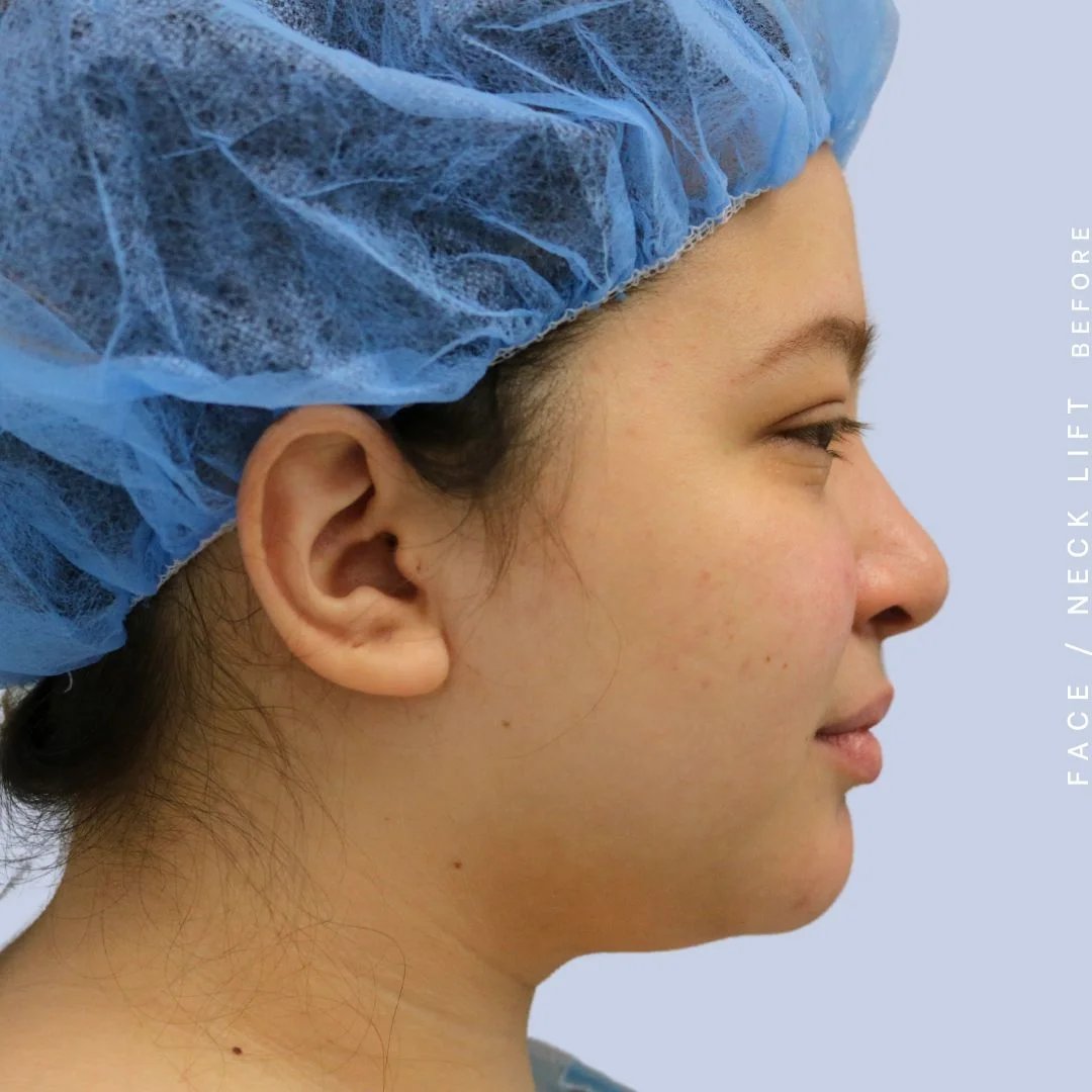 Face & Neck Before & After Gallery - Patient 108707434 - Image 9