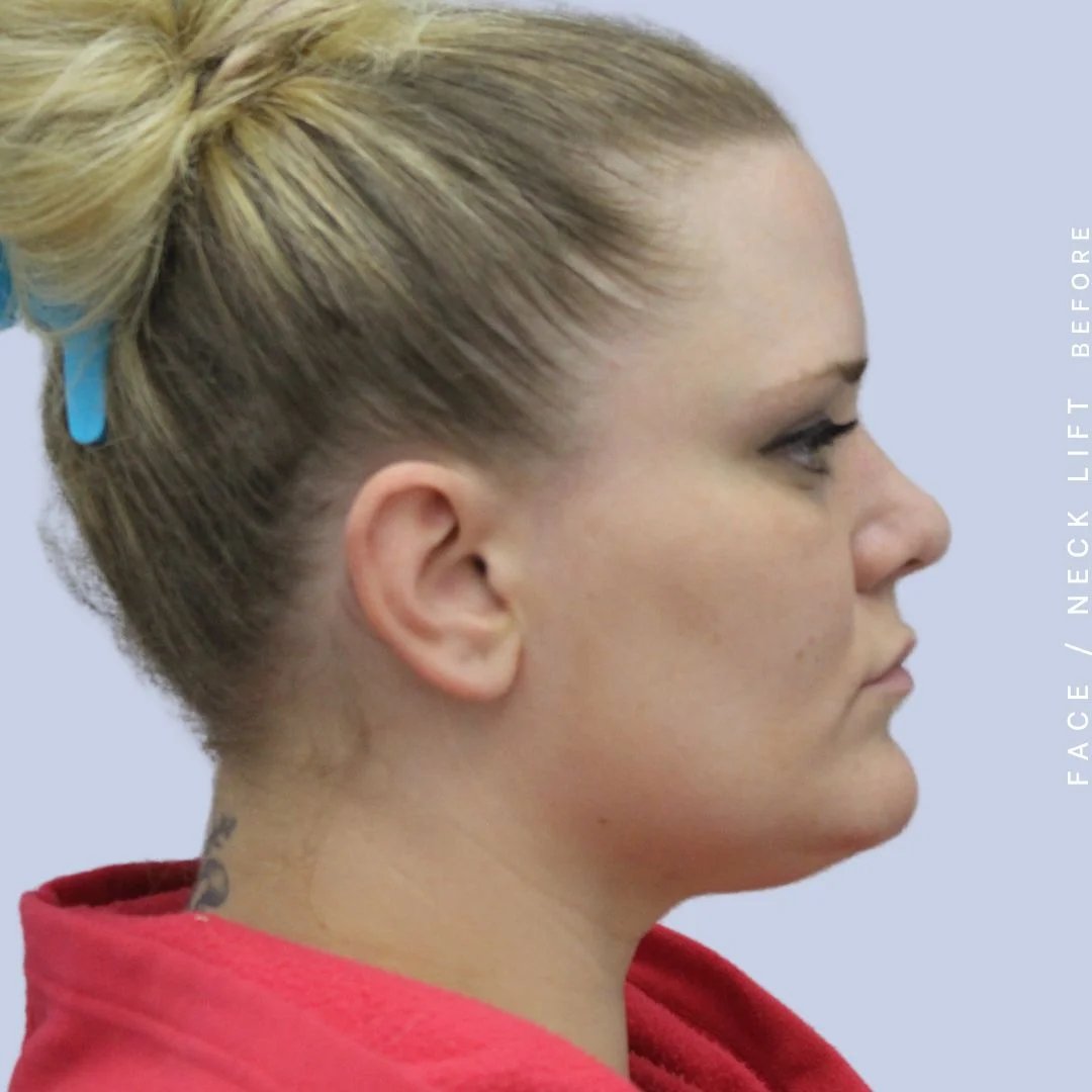 Face & Neck Before & After Gallery - Patient 108707489 - Image 3