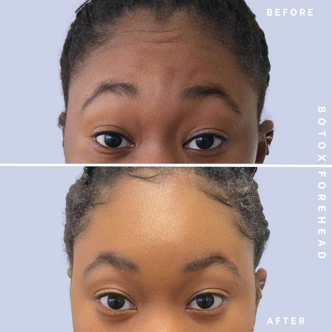Wrinkles Before & After Gallery - Patient 146645000 - Image 3