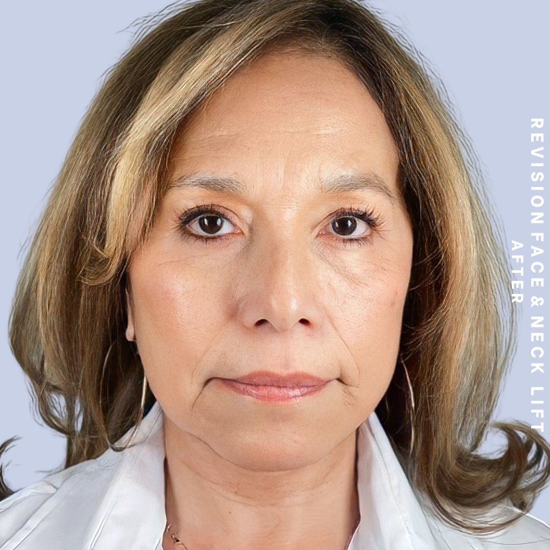 Face & Neck Before & After Gallery - Patient 145600105 - Image 2