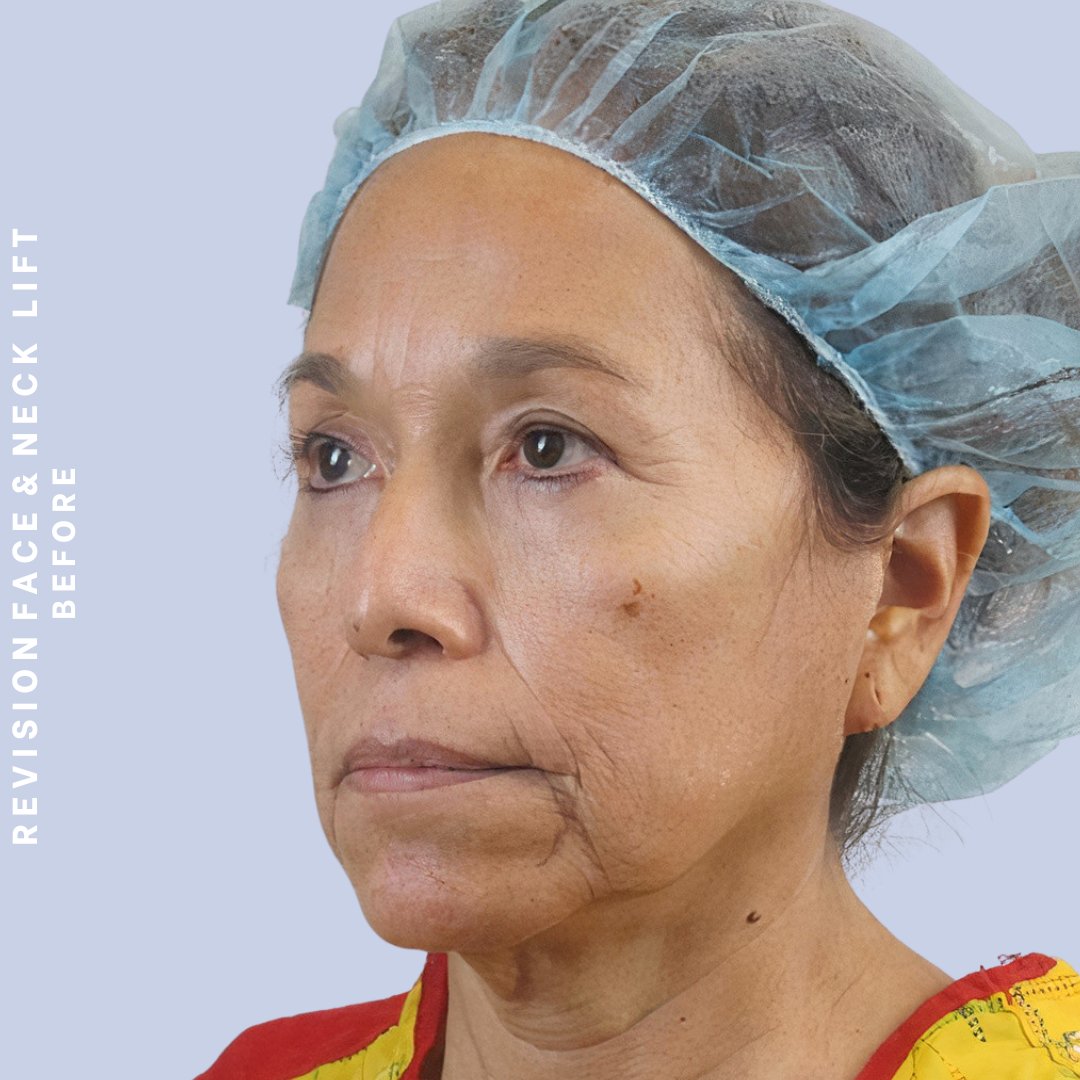 Face & Neck Before & After Gallery - Patient 145600105 - Image 9