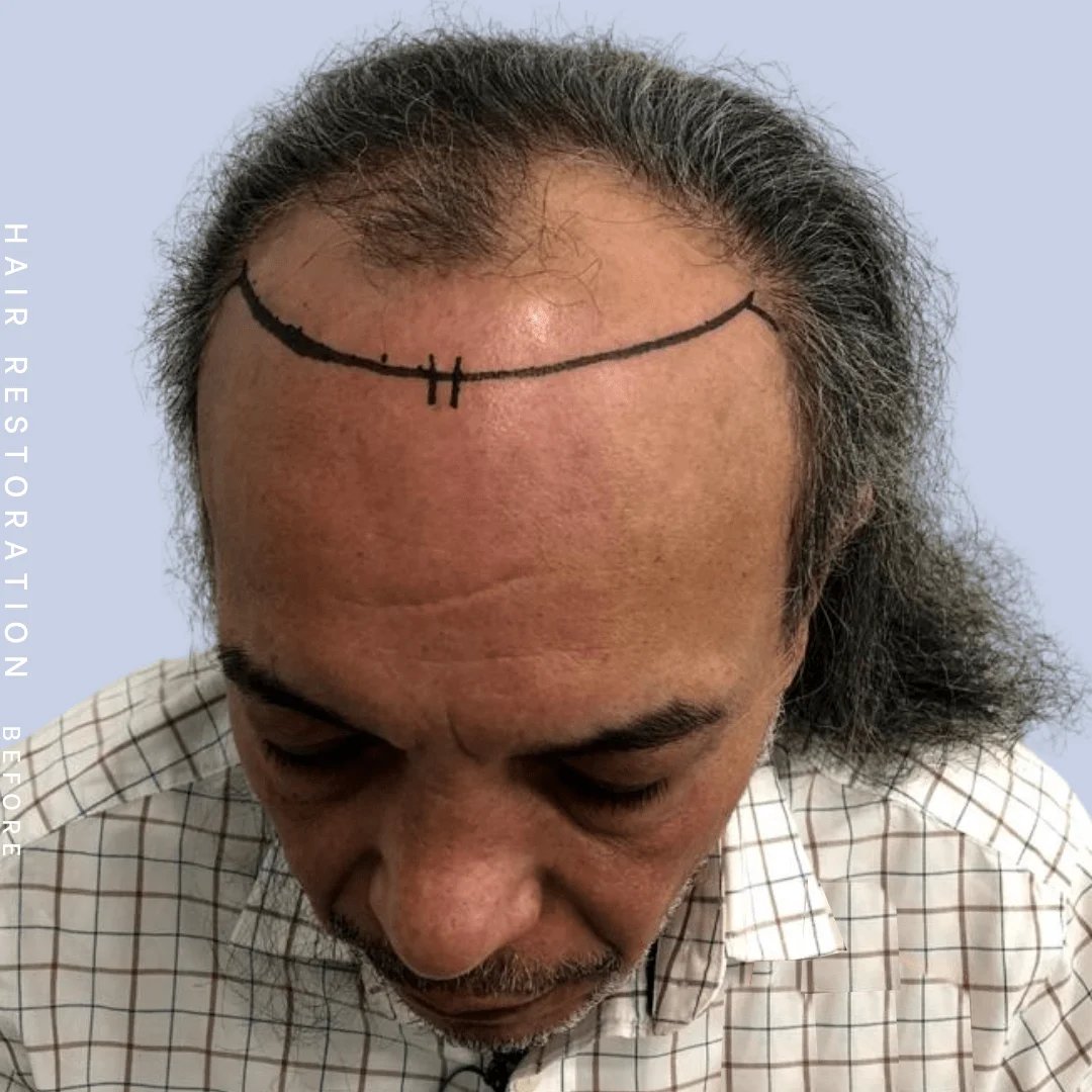 Hair Restoration Before & After Gallery - Patient 108743800 - Image 3