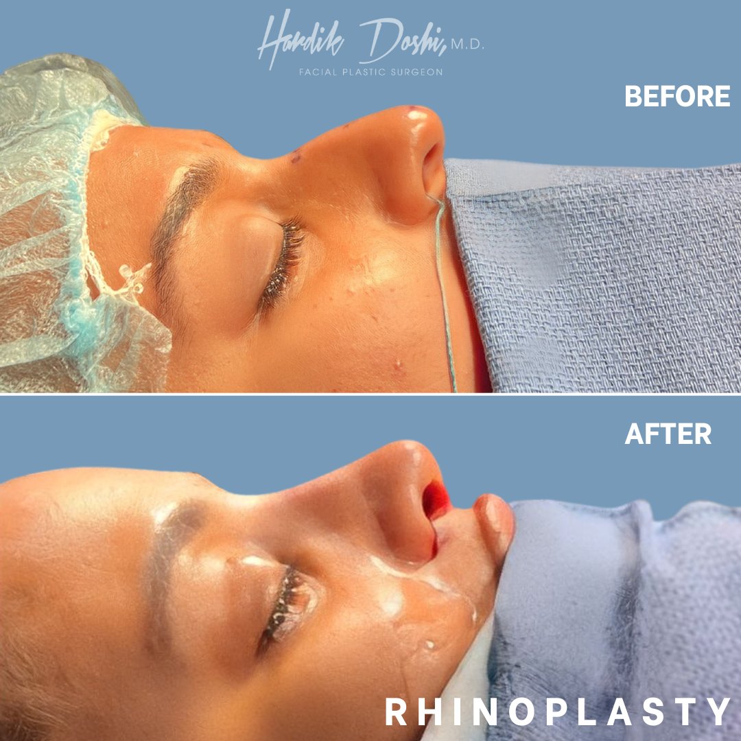 Dr. Hardik Doshi  Blog | Pre-Operative Instructions – Rhinoplasty