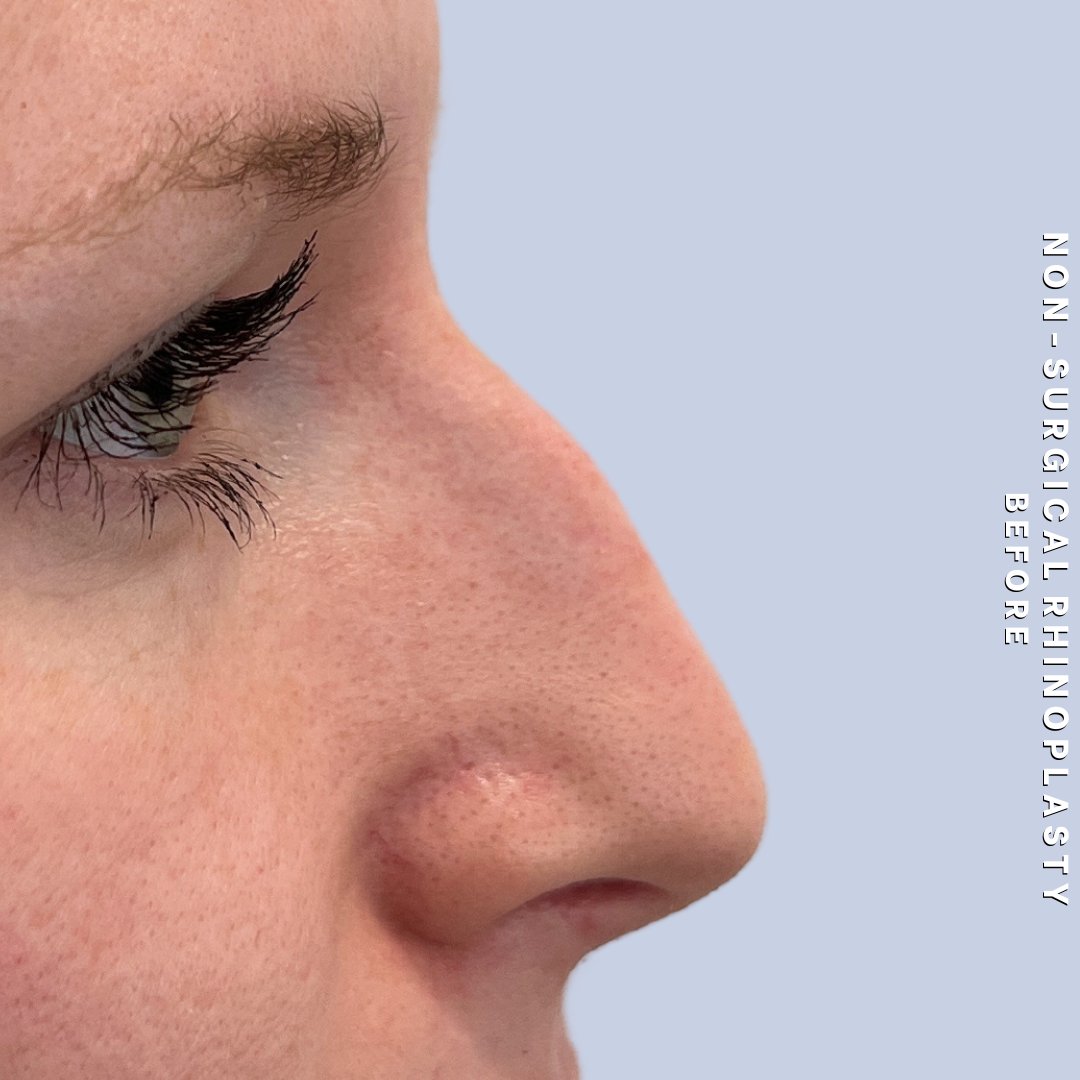 Non-Surgical Nose Before & After Gallery - Patient 400517 - Image 1