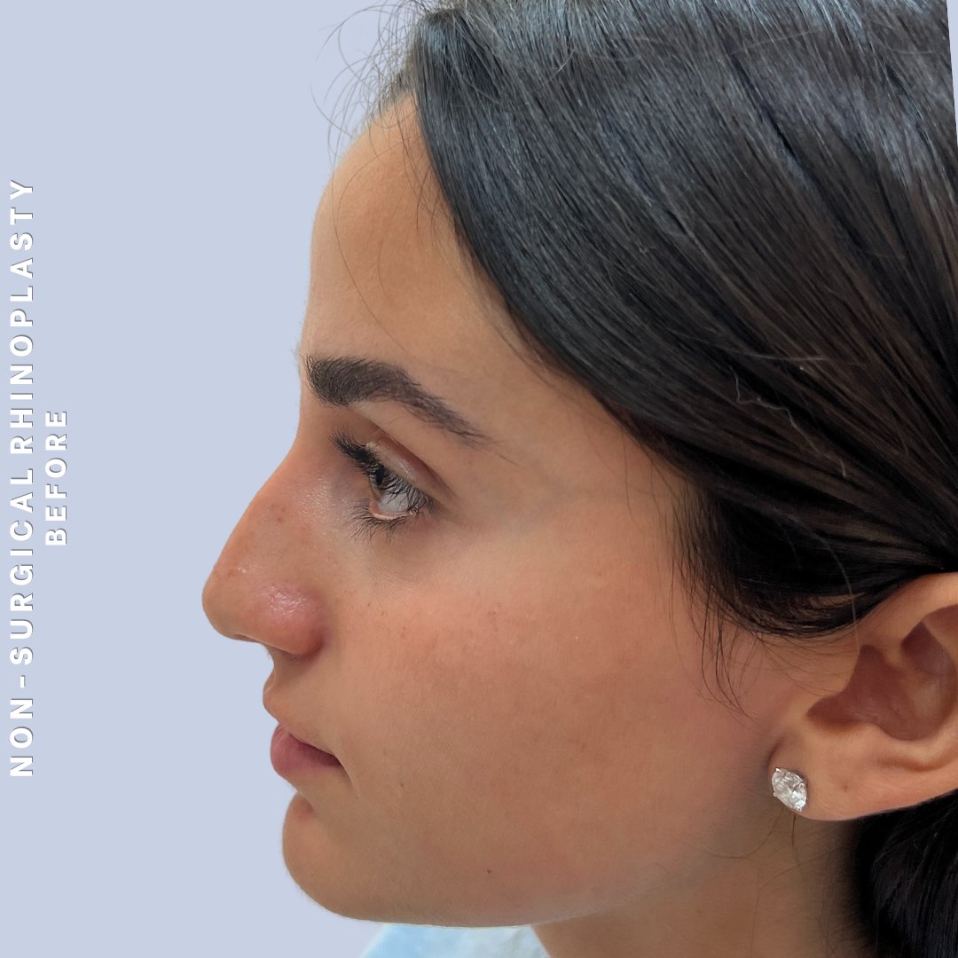 Non-Surgical Nose Before & After Gallery - Patient 102936 - Image 1