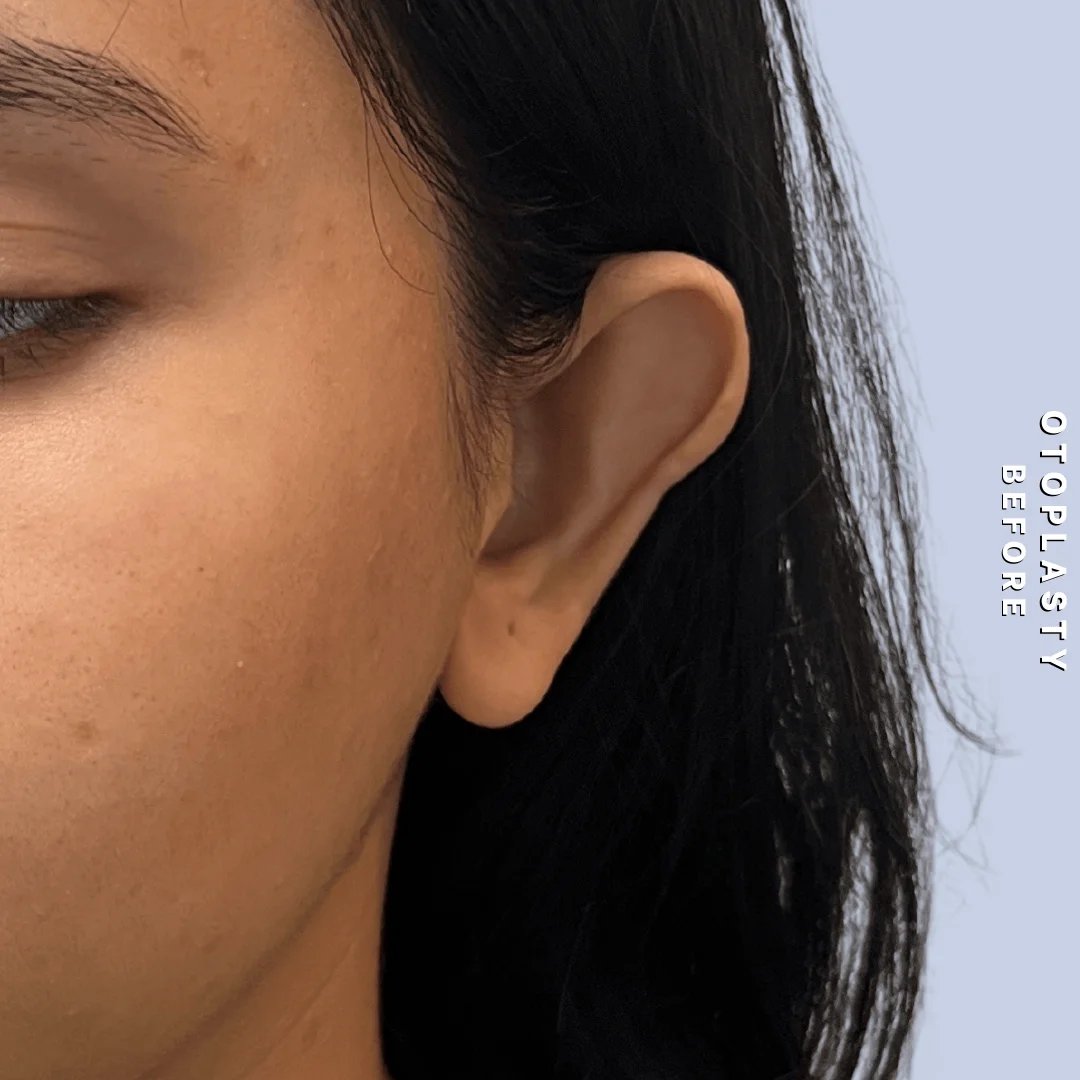 Ears Before & After Gallery - Patient 196133 - Image 1