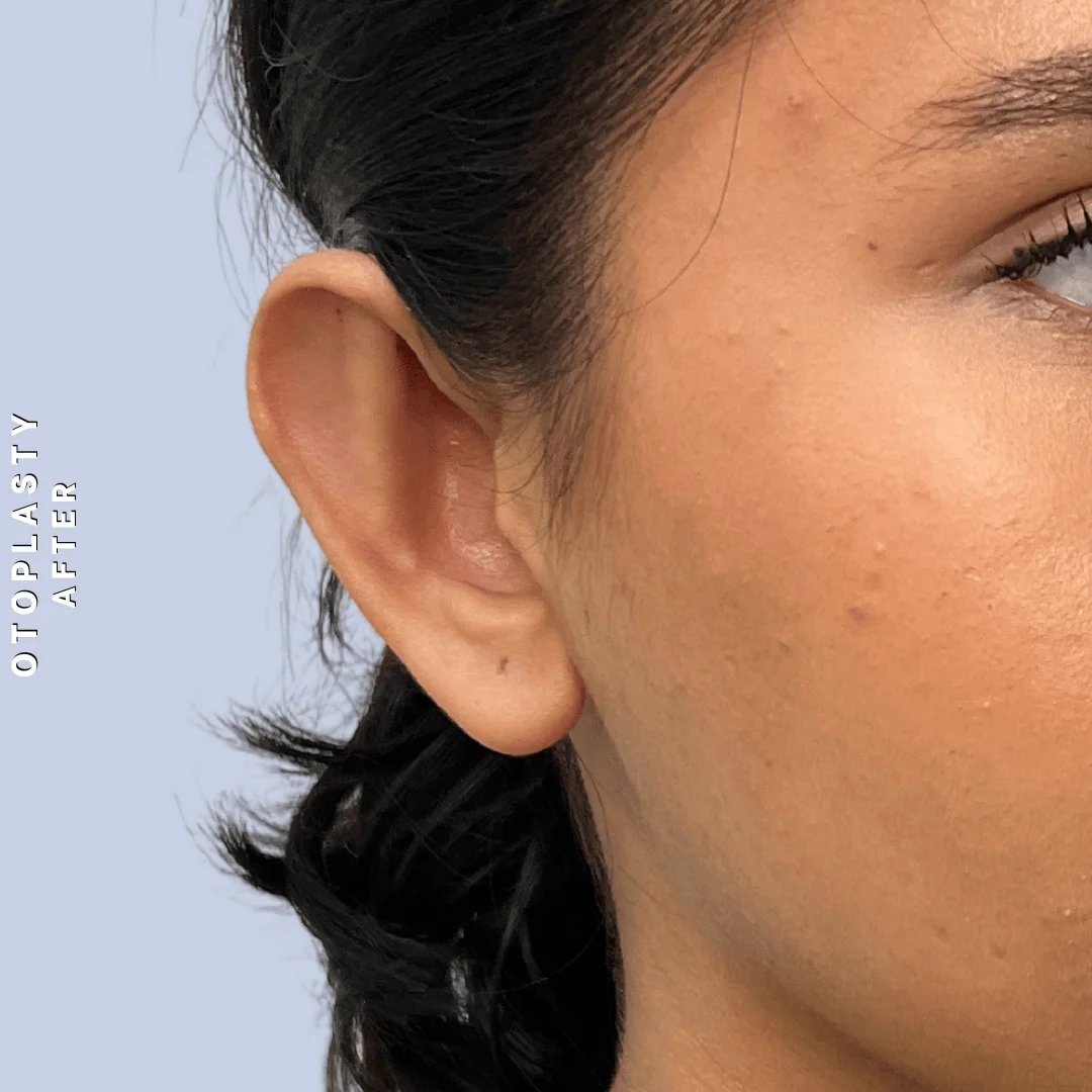 Ears Before & After Gallery - Patient 196133 - Image 4