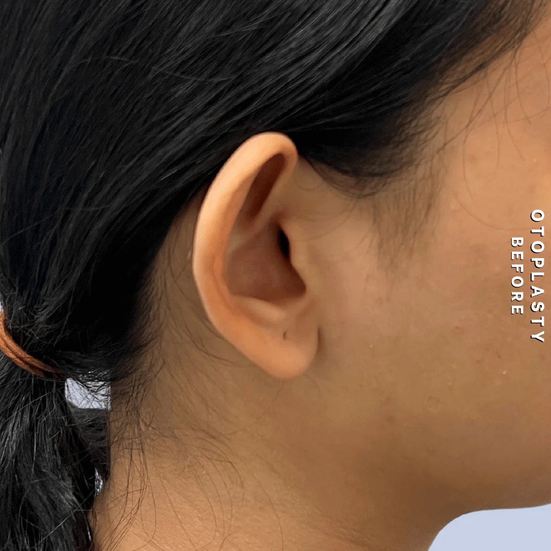 Ears Before & After Gallery - Patient 196133 - Image 5