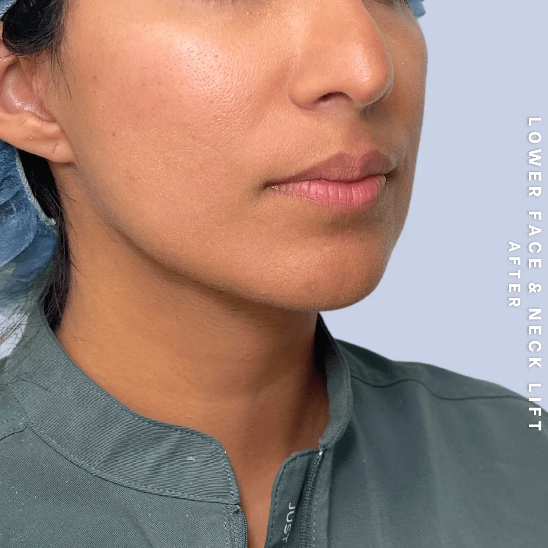 Face & Neck Before & After Gallery - Patient 393993 - Image 10