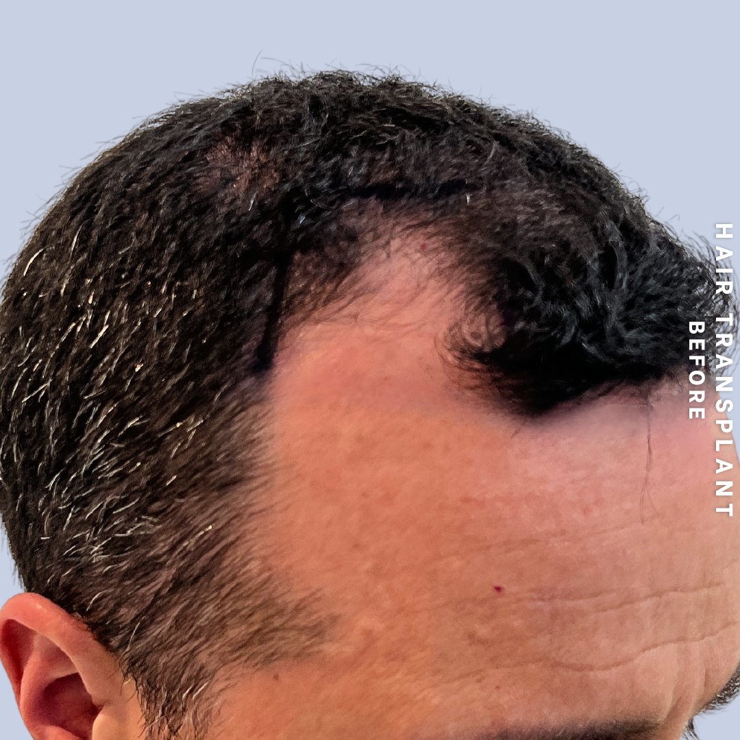 Hair Restoration Before & After Gallery - Patient 317208 - Image 1