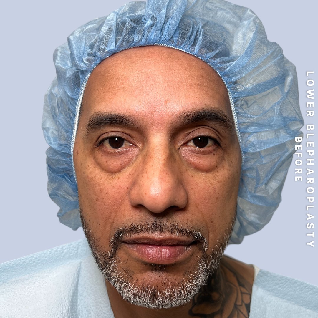 Men's Eyes Before & After Gallery - Patient 320513 - Image 1