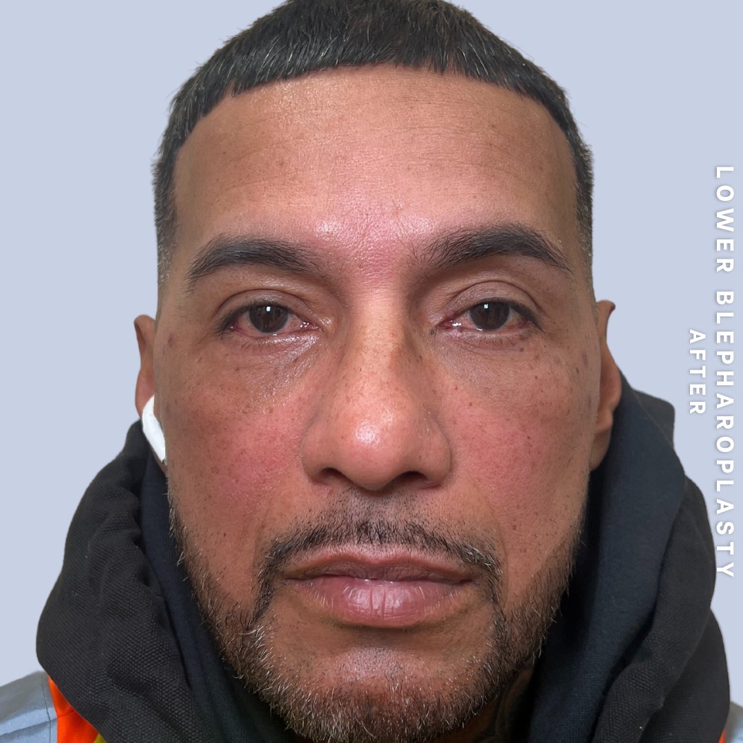 Men's Eyes Before & After Gallery - Patient 320513 - Image 2
