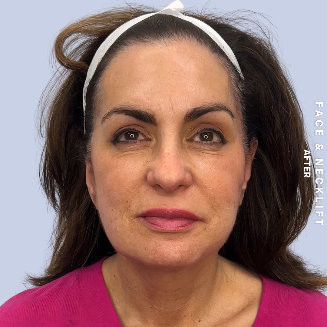 Face & Neck Before & After Gallery - Patient 271682 - Image 2