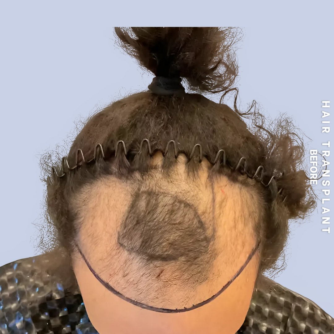 Hair Restoration Before & After Gallery - Patient 777254 - Image 1