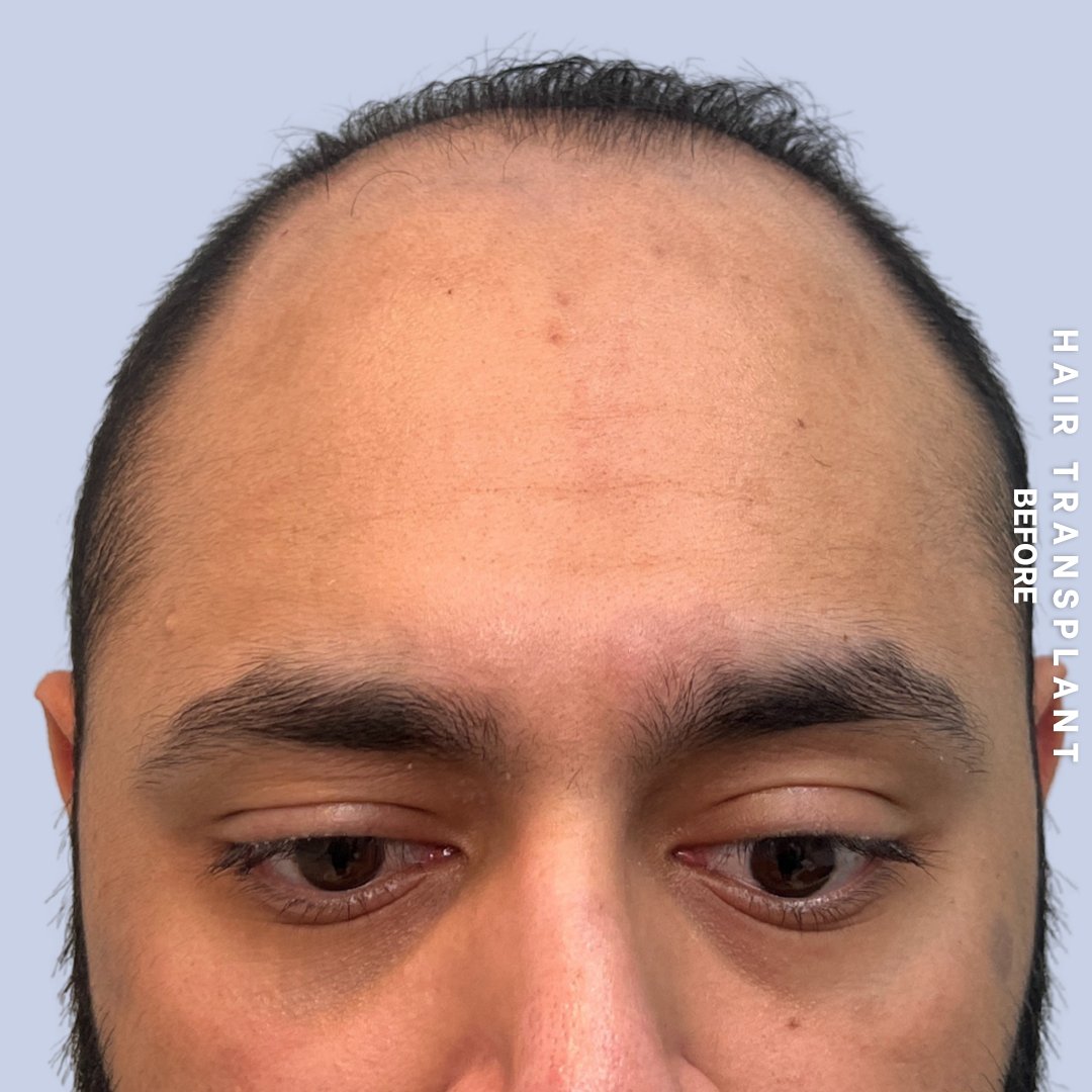 Hair Restoration Before & After Gallery - Patient 130289 - Image 1