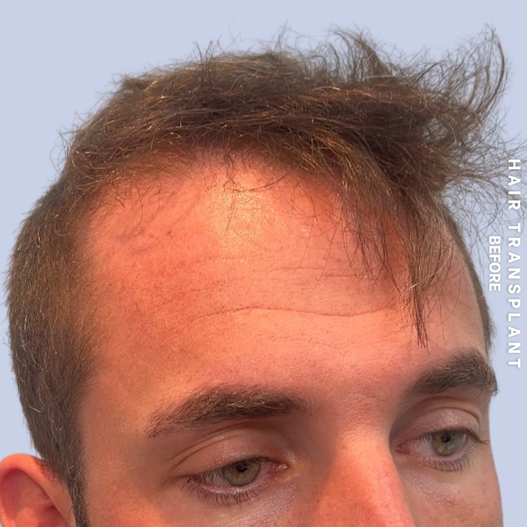 Hair Restoration Before & After Gallery - Patient 226752 - Image 1