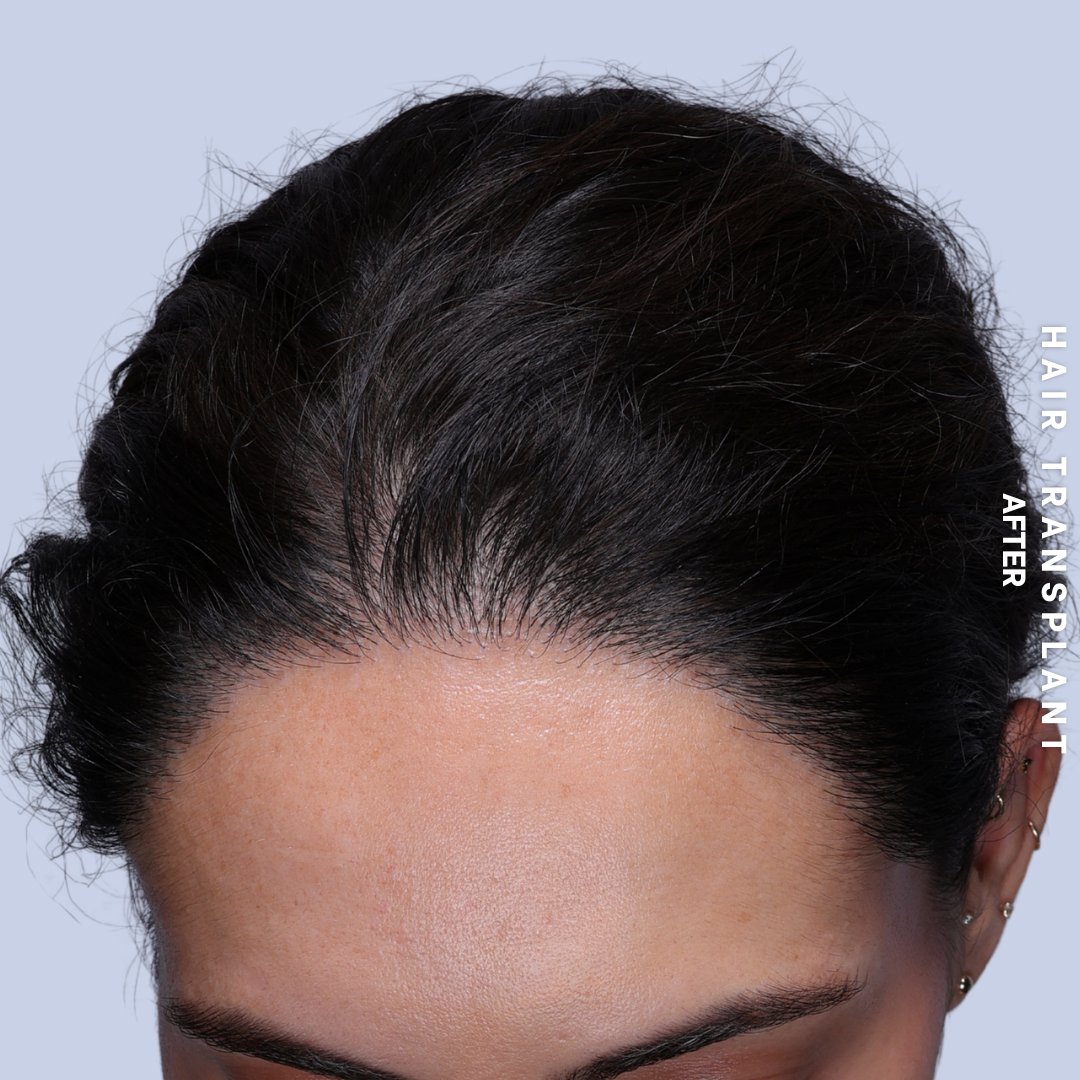 Hair Restoration Before & After Gallery - Patient 463895 - Image 4