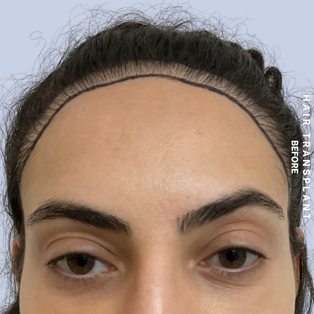 Hair Restoration Before & After Gallery - Patient 463895 - Image 1