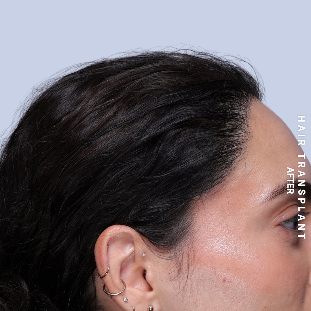 Hair Restoration Before & After Gallery - Patient 463895 - Image 8