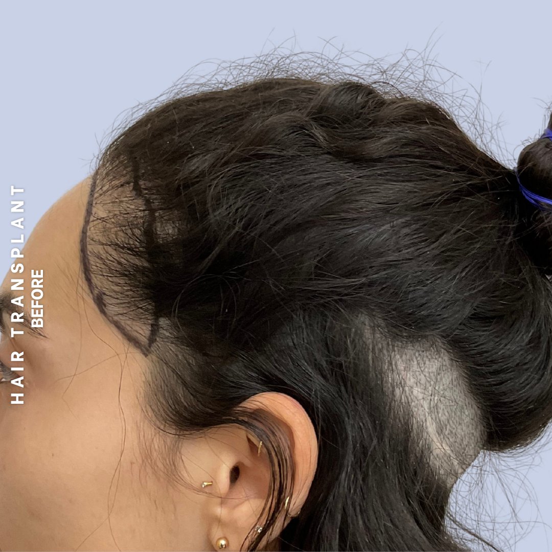 Hair Restoration Before & After Gallery - Patient 463895 - Image 11