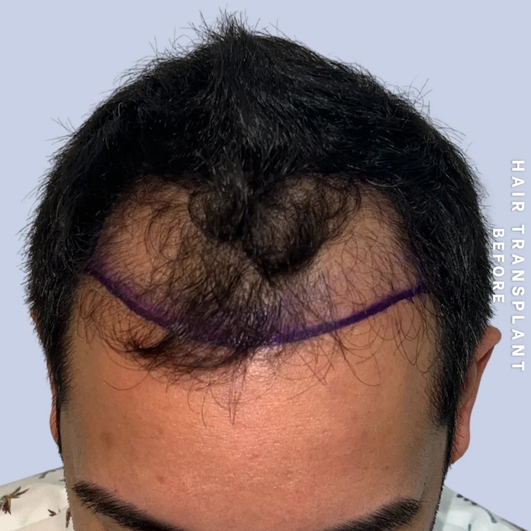 Hair Restoration Before & After Gallery - Patient 383698 - Image 1
