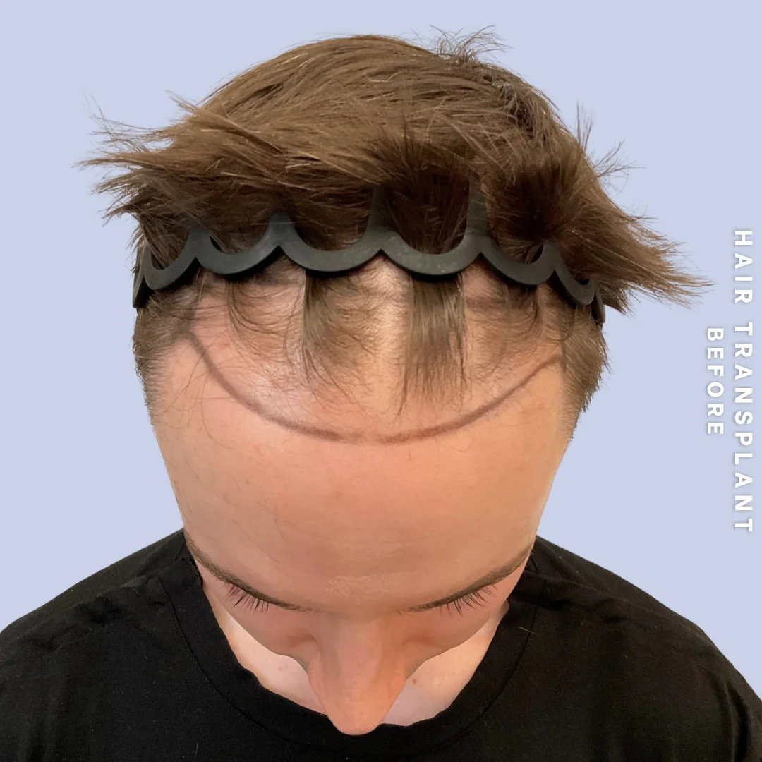 Hair Restoration Before & After Gallery - Patient 362220 - Image 1
