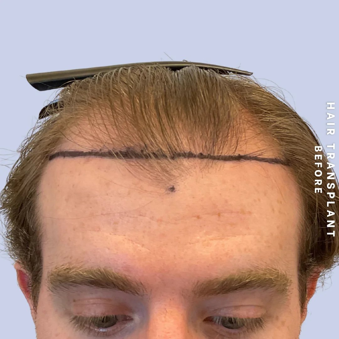 Hair Restoration Before & After Gallery - Patient 294070 - Image 1