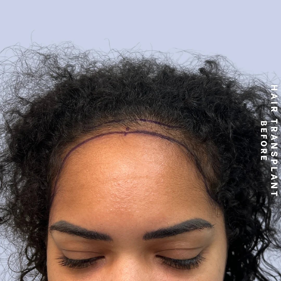 Hair Restoration Before & After Gallery - Patient 109913 - Image 1
