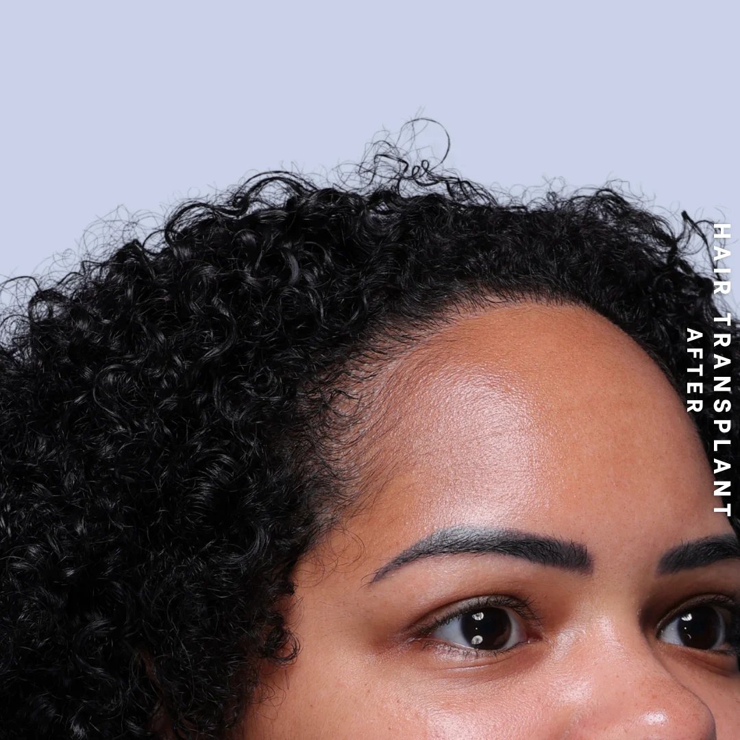 Hair Restoration Before & After Gallery - Patient 109913 - Image 10