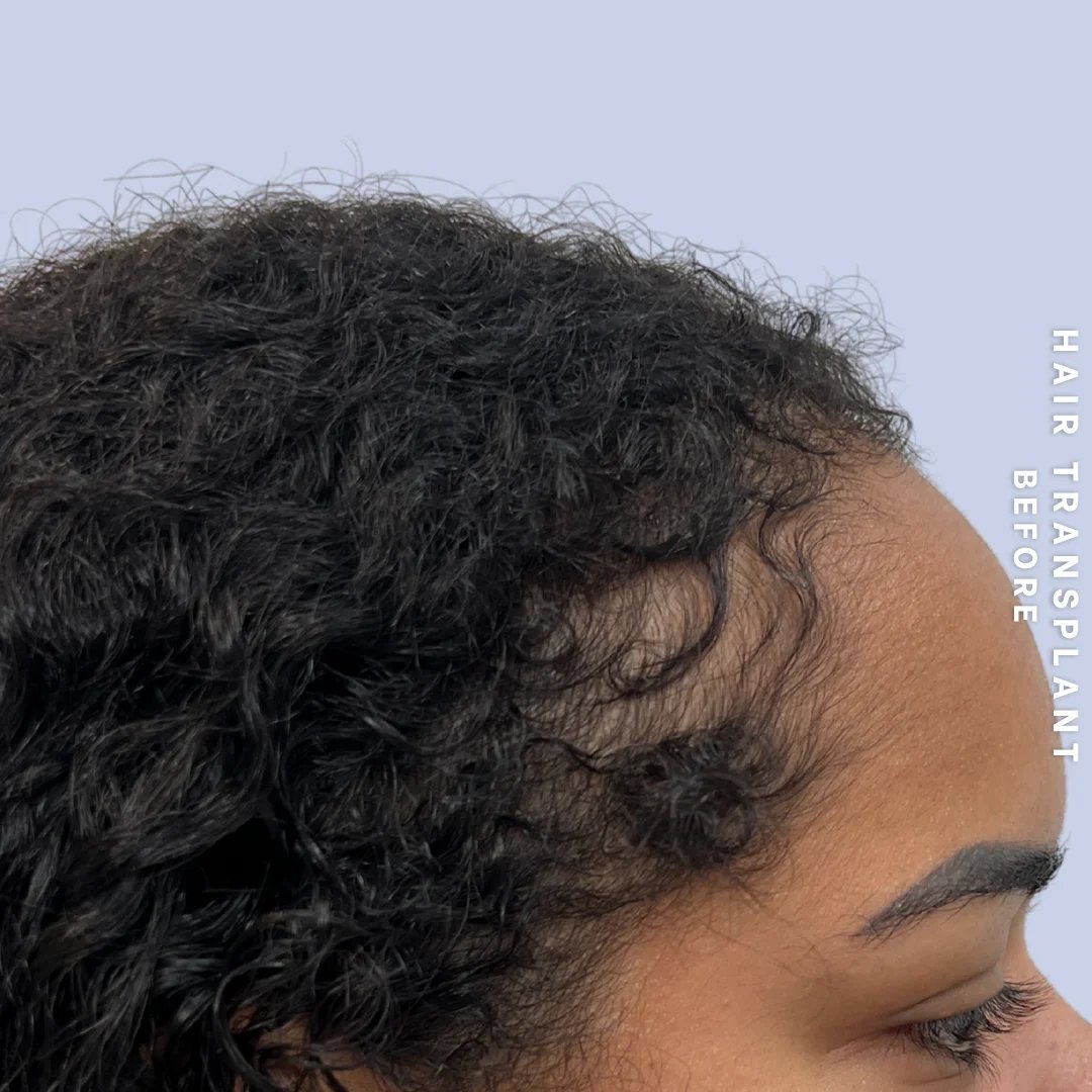 Hair Restoration Before & After Gallery - Patient 109913 - Image 5