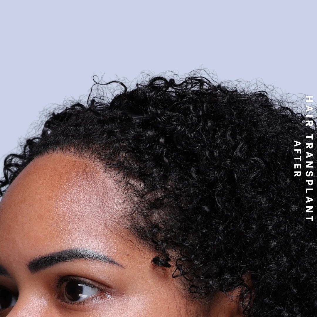 Hair Restoration Before & After Gallery - Patient 109913 - Image 8