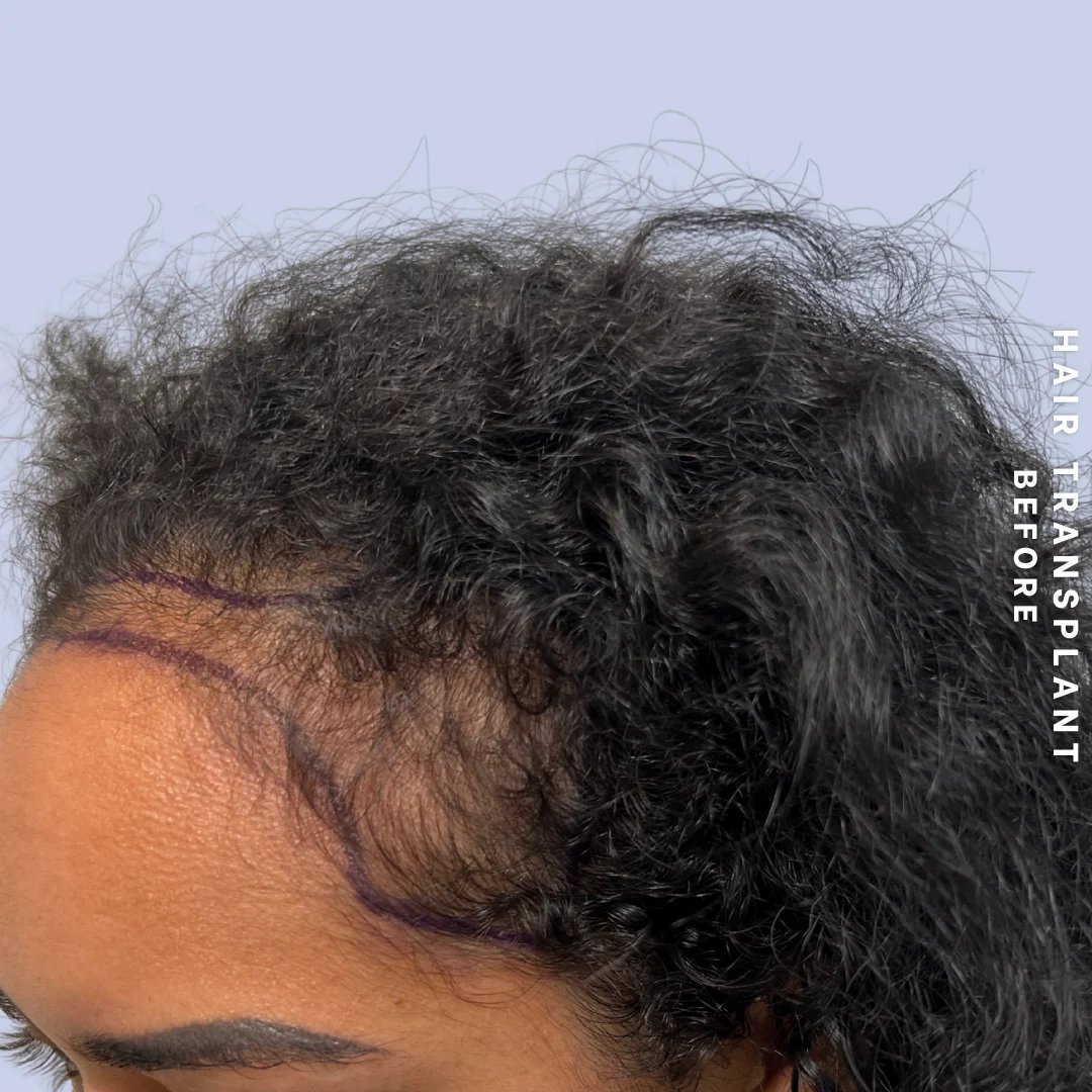 Hair Restoration Before & After Gallery - Patient 109913 - Image 7