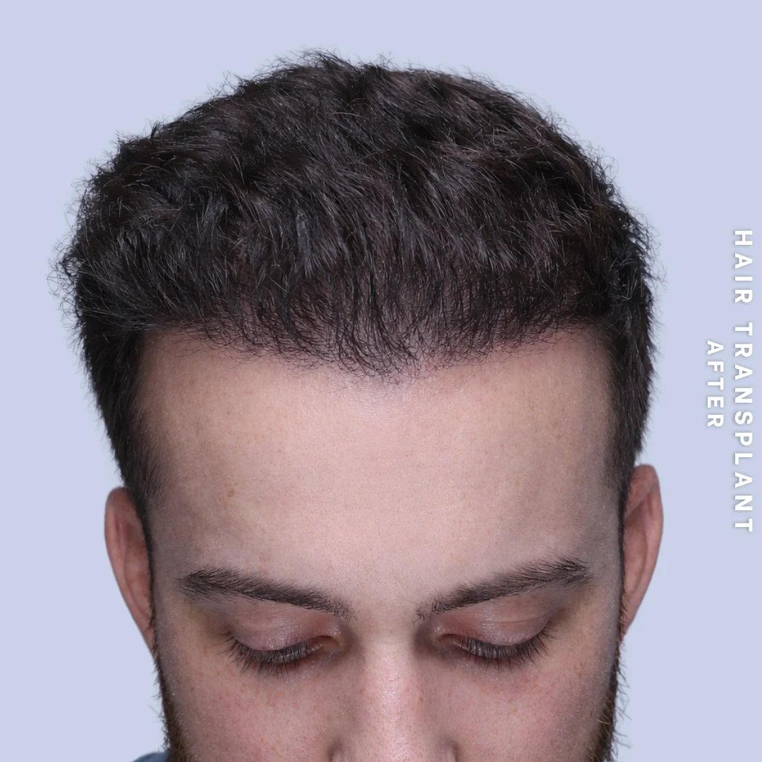 Men's Hair Before & After Gallery - Patient 914956 - Image 2