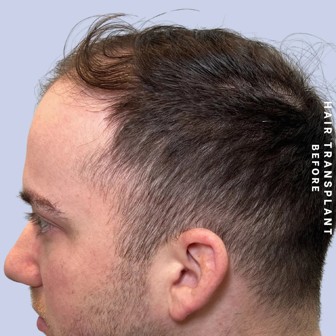 Men's Hair Before & After Gallery - Patient 914956 - Image 5