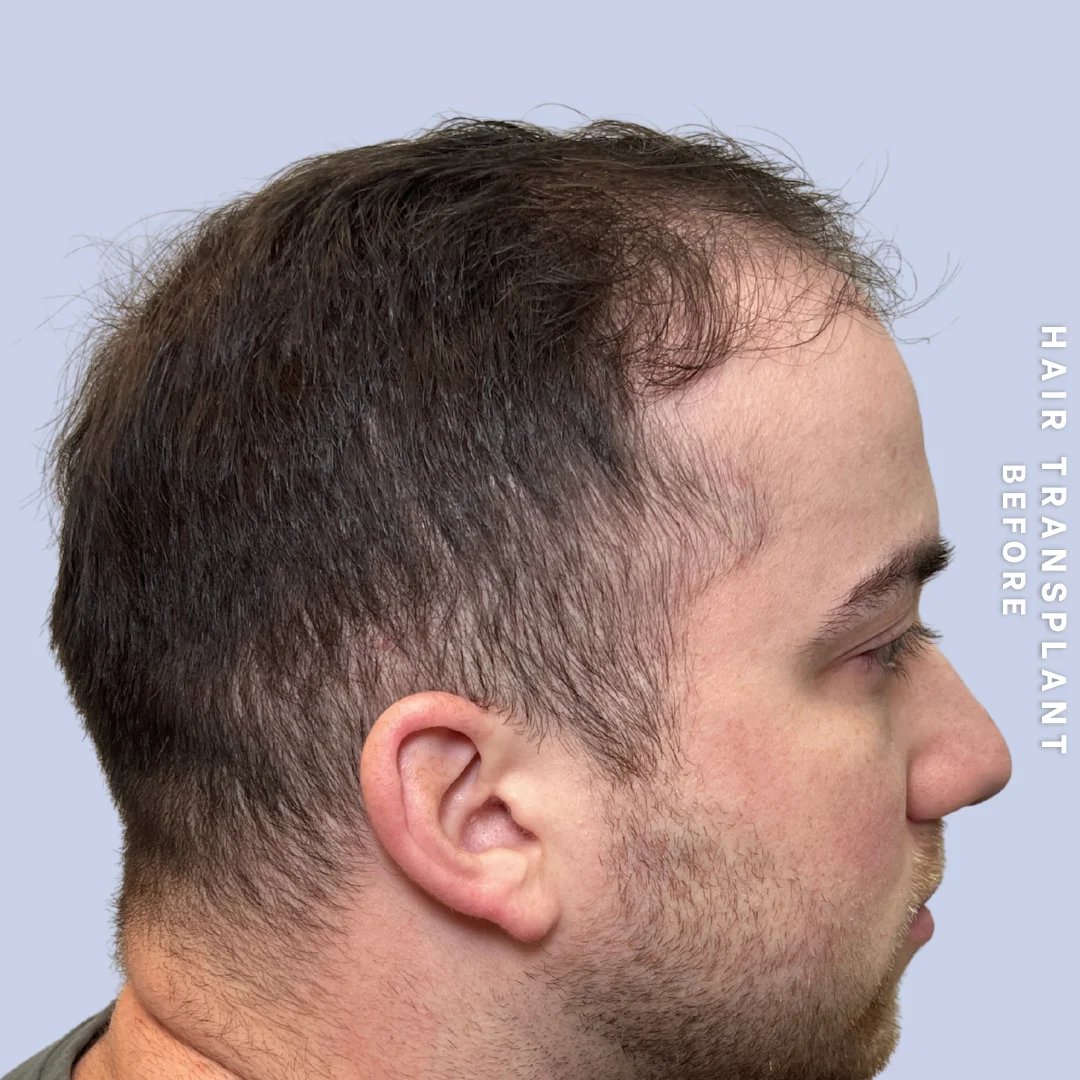 Men's Hair Before & After Gallery - Patient 914956 - Image 3