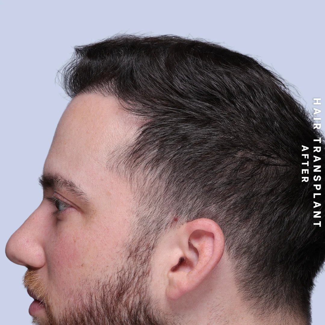 Men's Hair Before & After Gallery - Patient 914956 - Image 6