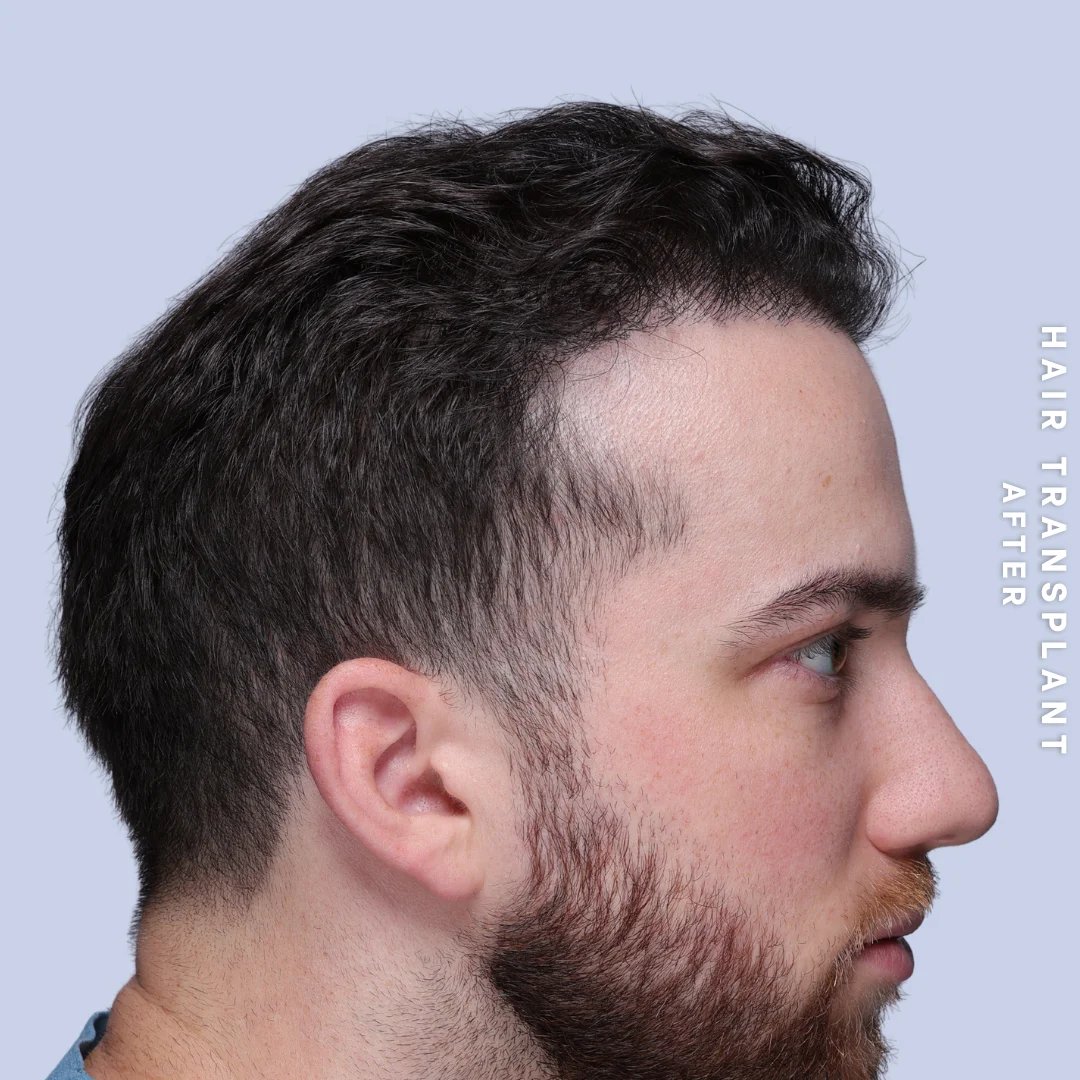 Men's Hair Before & After Gallery - Patient 914956 - Image 4