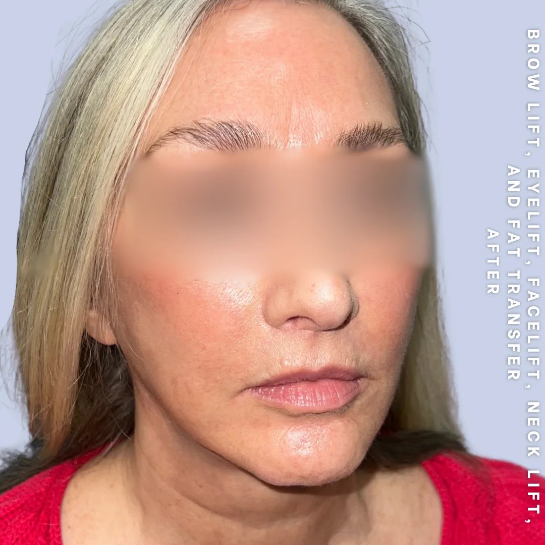 Face & Neck Before & After Gallery - Patient 18 - Image 1