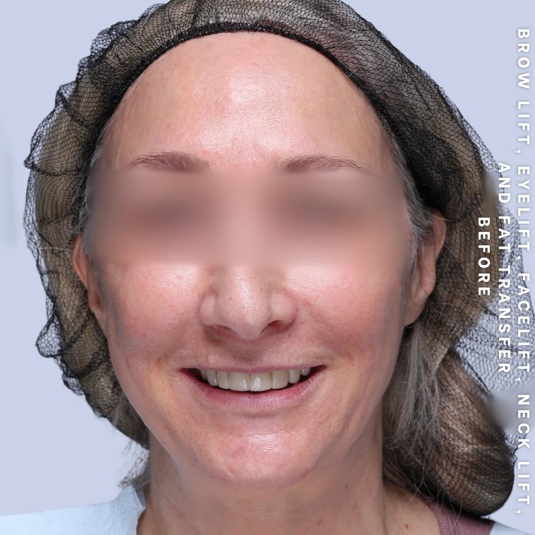 Face & Neck Before & After Gallery - Patient 18 - Image 2